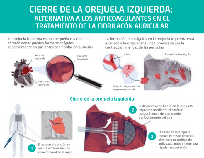 "El cierre de orejuela es una alternativa eficaz para pacientes con fibrilación auricular que no pueden tomar anticoagulantes", doctor José Ramón Rumoroso, jefe de Cardiología del Hospital Quirónsalud Bizkaia